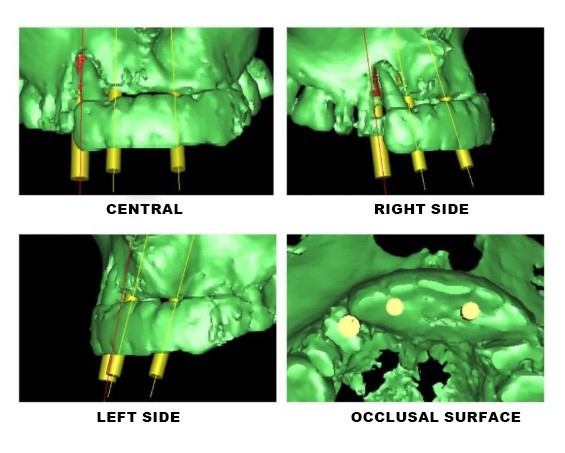 Digital Implant Design-1 Digital Implant Design-1
