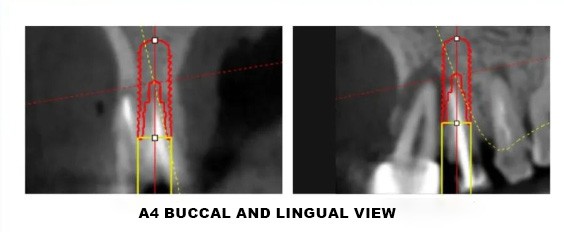 Digital Implant Design-3 Digital Implant Design-3