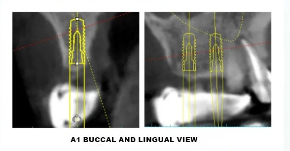 Digital Implant Design-4 Digital Implant Design-4