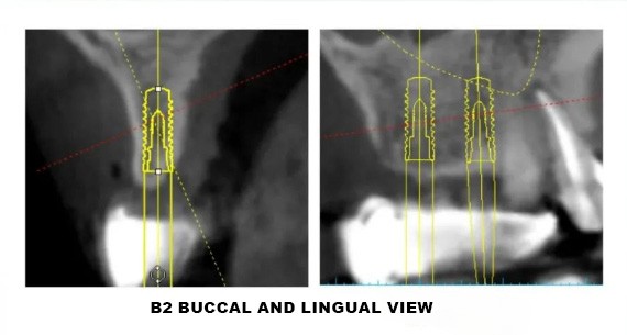 Digital Implant Design-5 Digital Implant Design-5
