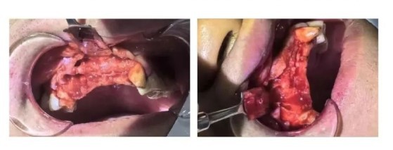 Surgical Procedure-1 Surgical Procedure-1