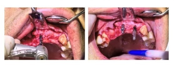 Surgical Procedure-4 Surgical Procedure-4