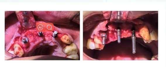 Surgical Procedure-5 Surgical Procedure-5