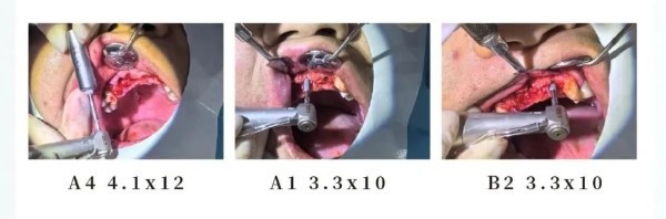 manners-apex-system-dental-implant manners-apex-system-dental-implant