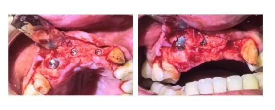 Sequential implantation of three Manners Apex dental implants Sequential implantation of three Manners Apex dental implants