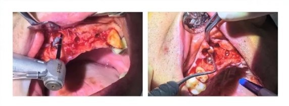 Surgical Procedure-6 Surgical Procedure-6