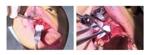 Surgical Procedure-7 Surgical Procedure-7