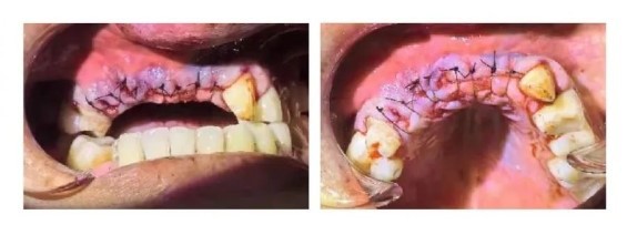 Surgical Procedure-8 Surgical Procedure-8