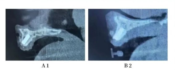 Postoperative Cone Beam Computed Tomography CBCT-2 Postoperative Cone Beam Computed Tomography CBCT-2