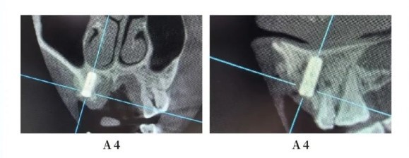 Postoperative Cone Beam Computed Tomography CBCT-1 Postoperative Cone Beam Computed Tomography CBCT-1