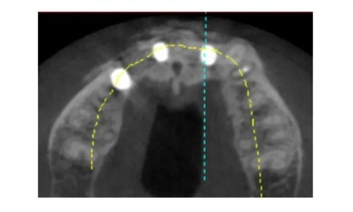 Postoperative Cone Beam Computed Tomography CBCT-3 Postoperative Cone Beam Computed Tomography CBCT-3