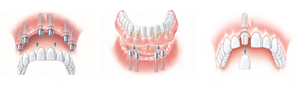 Wide Range Of Indications-dental implants Wide Range Of Indications-dental implants