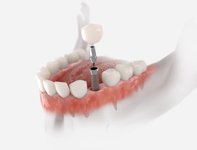 Protection Of Neighboring Teeth Protection Of Neighboring Teeth