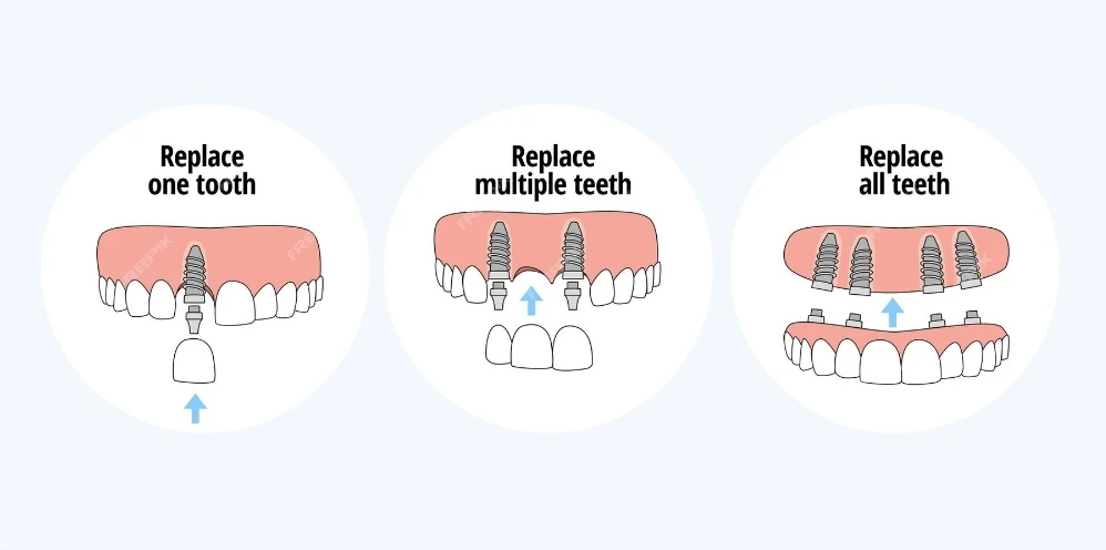 Wide Range Of Indications-dental implants1 Wide Range Of Indications-dental implants1