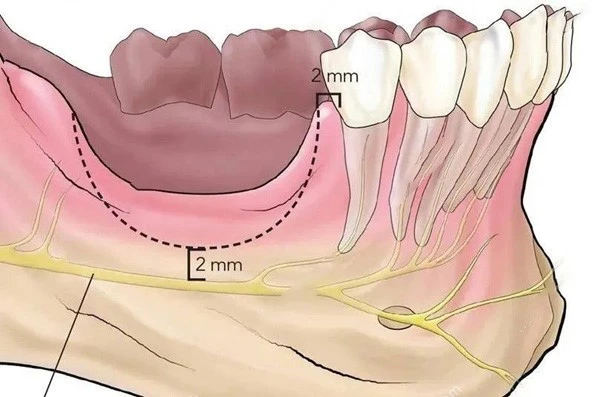 Protection Of Alveolar Bone Protection Of Alveolar Bone