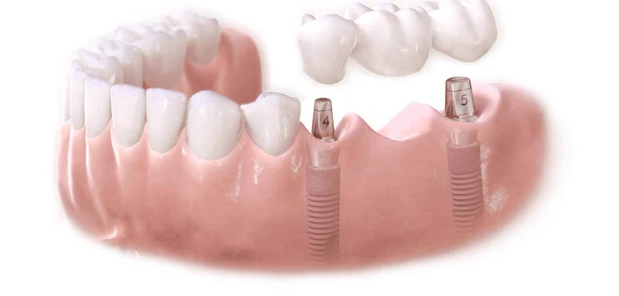 Long Service Life-dental implants Long Service Life-dental implants