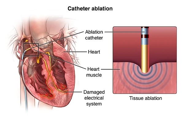 Radiofrequency Ablation Radiofrequency Ablation