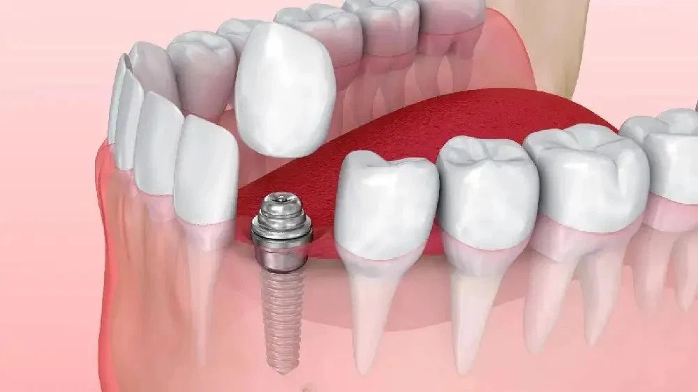 Fixed Implant-Supported Dentures Fixed Implant-Supported Dentures