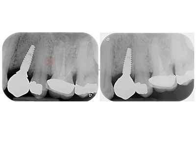 Ten Key Points for Clinical Follow-Up of Dental Implants