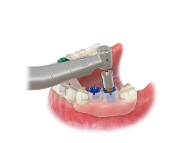 Unveiling the Complete Implant Placement Process: What Pitfalls Remain After ...