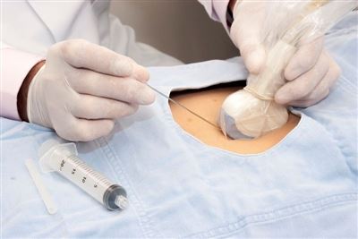 Breast Cancer Biopsy: Risks of Metastasis, Fine Needle vs. Core Needle, and 1...