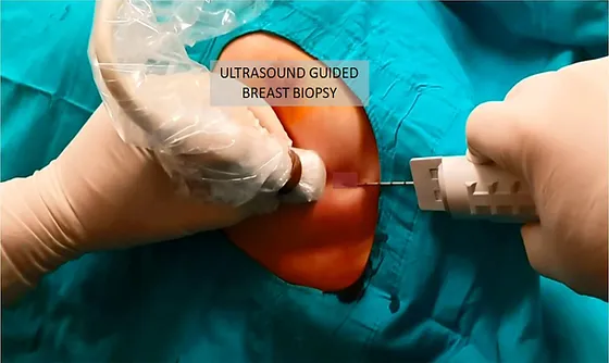 Breast Biopsy: What Is It and Why Has My Doctor Recommended One?