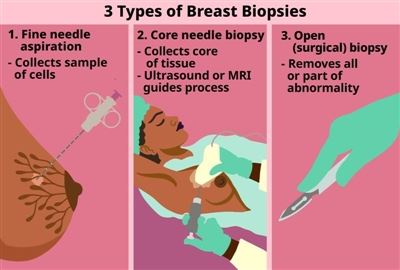 A Comprehensive Guide to Breast Biopsy: Everything You Need to Know