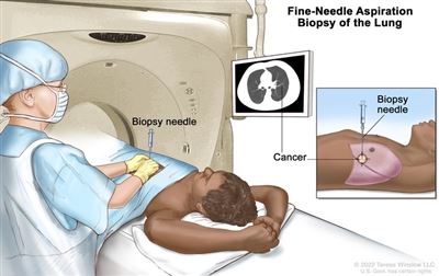 What Is Fine Needle Aspiration Biopsy
