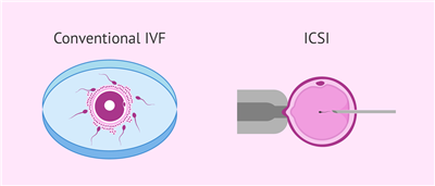 IVF Egg Retrieval: Common Questions Answered