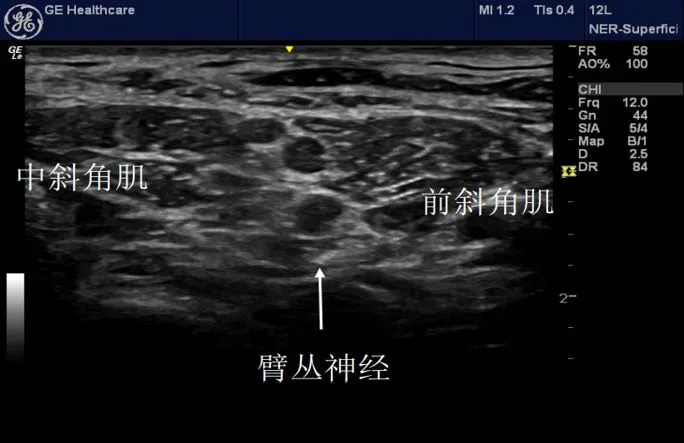 the anterior scalene muscle, middle scalene muscle, transverse processes of the vertebrae, carotid artery, vertebral artery, and phrenic nerve. the anterior scalene muscle, middle scalene muscle, transverse processes of the vertebrae, carotid artery, vertebral artery, and phrenic nerve.