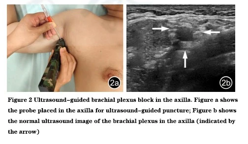 Axillary Brachial Plexus Block Axillary Brachial Plexus Block