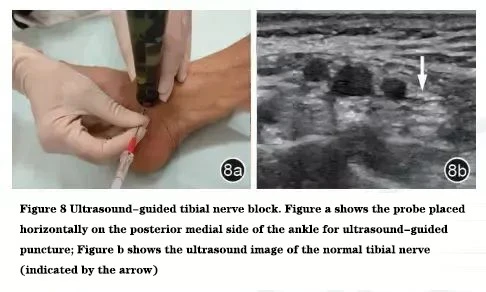 Tibial Nerve Block Tibial Nerve Block