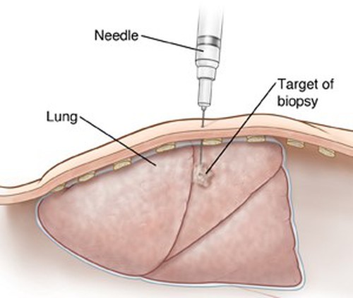 process of Fine Needle Aspiration Biopsy process of Fine Needle Aspiration Biopsy
