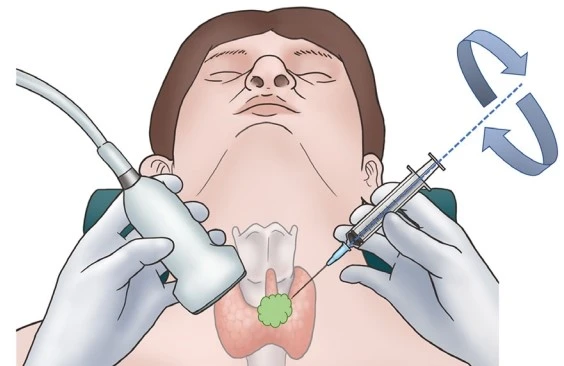 Diagram of a fine needle aspiration biopsy performed under ultrasound guidance Diagram of a fine needle aspiration biopsy performed under ultrasound guidance