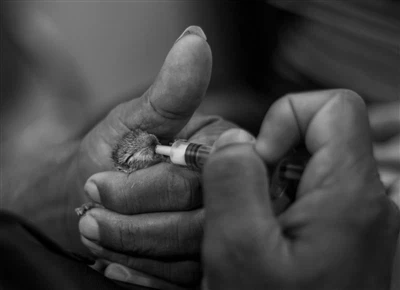 Interpretation Of The Clinical Value Of Puncture Needles - A Clinical Orienta...