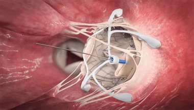 Precision Heart Valve